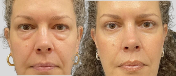 mpsg before and after blepharoplasty results mpsg before and after blepharoplasty results