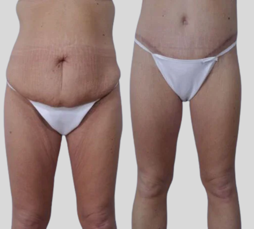 mpsg before and after body lift results () mpsg before and after body lift results ()