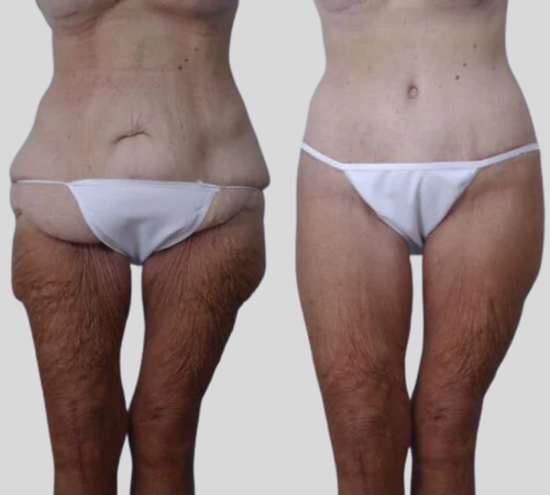 mpsg before and after body lift results mpsg before and after body lift results