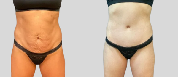 mpsg before and after tummy tuck results () mpsg before and after tummy tuck results ()