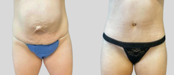 mpsg before and after tummy tuck results mpsg before and after tummy tuck results