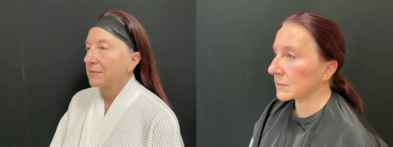 facelift before and after photo by my plastic surgery group in carmel in
