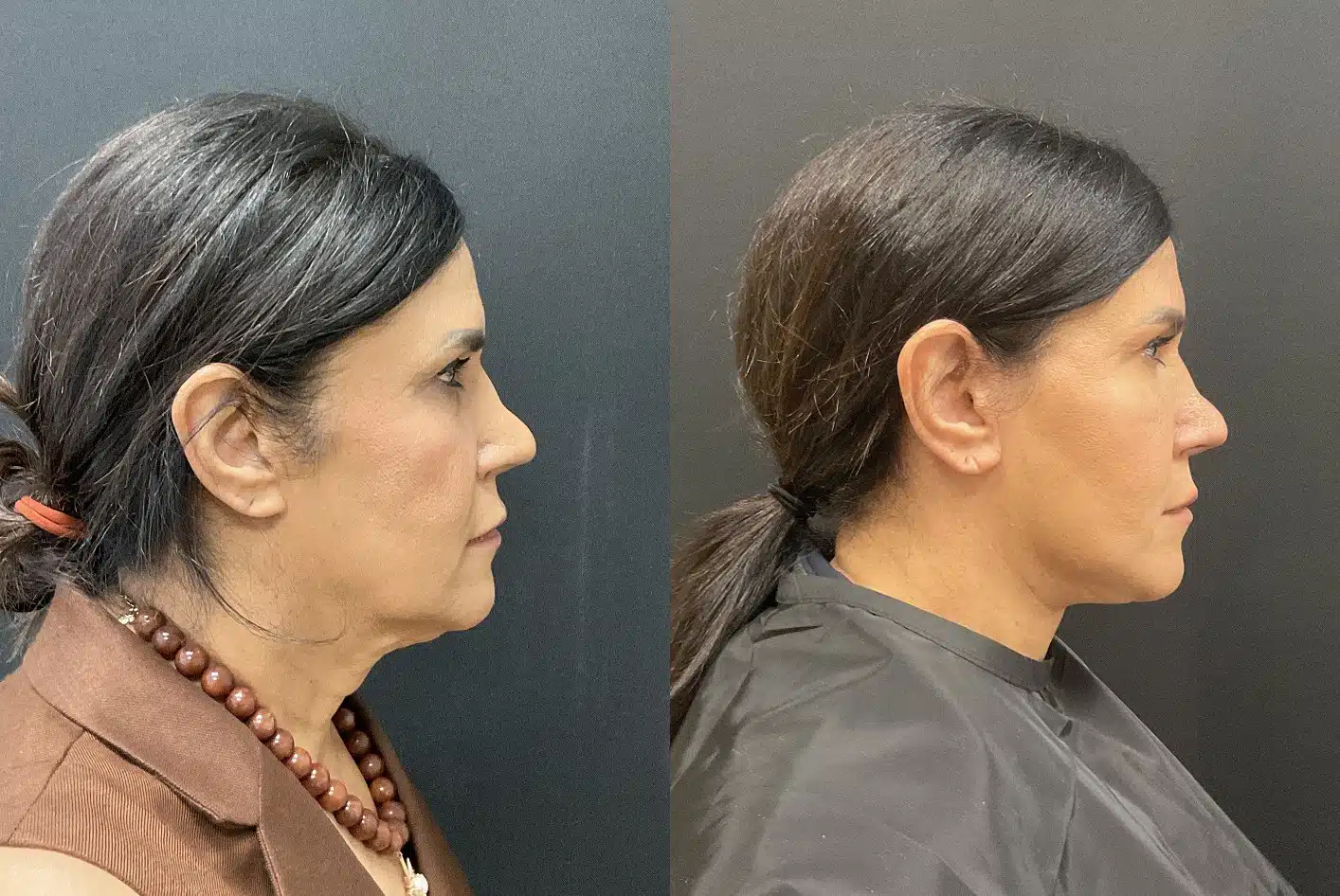 facelift before and after photo by my plastic surgery group in carmel in