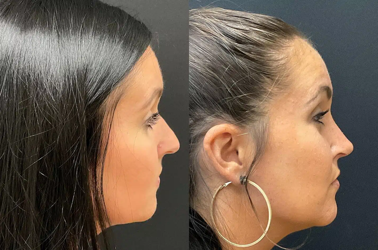 rhinoplasty before and after photo by my plastic surgery group in carmel in