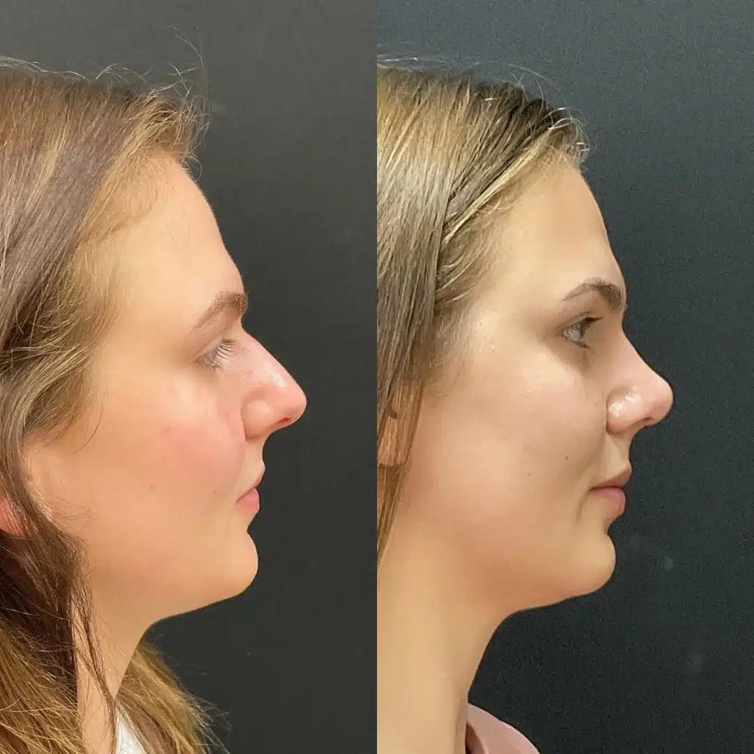 rhinoplasty before and after photo by my plastic surgery group in carmel in