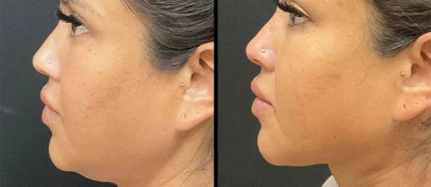 before and after facial rejuvenation () before and after facial rejuvenation ()