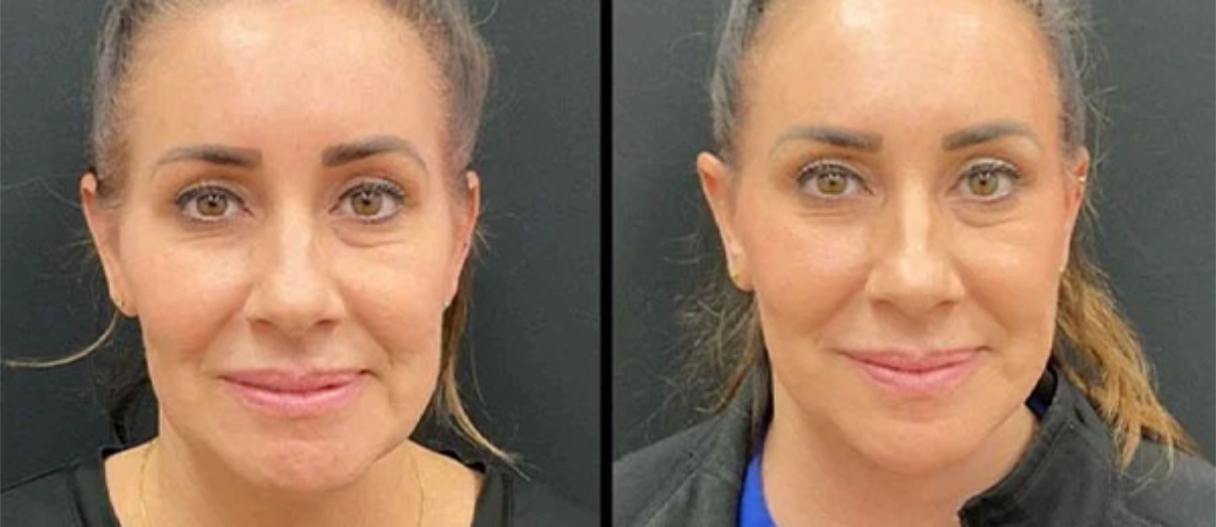 before and after facial rejuvenation () before and after facial rejuvenation ()