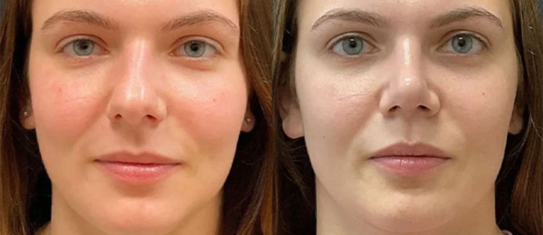 before and after facial rejuvenation () before and after facial rejuvenation ()