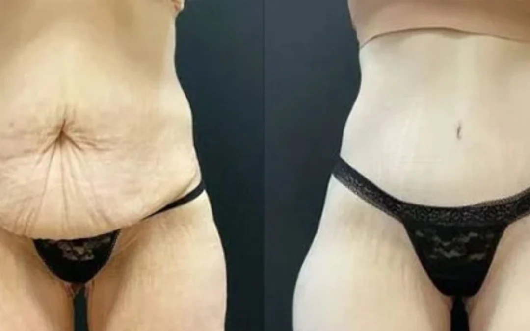 before and after post weight loss body lift before and after post weight loss body lift