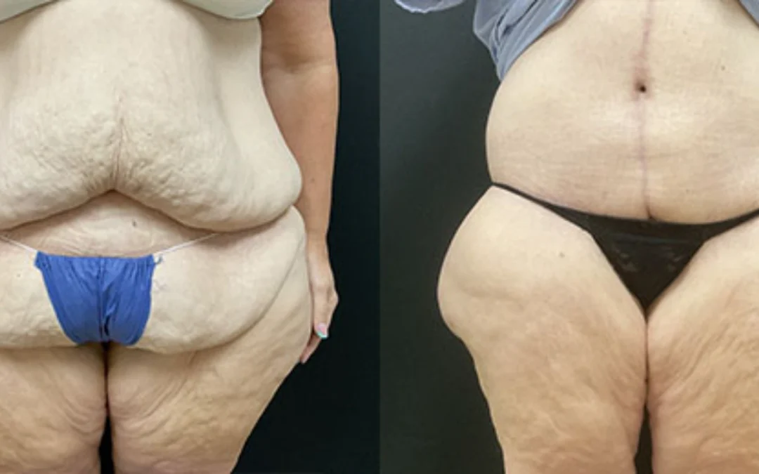 before and after post weight loss body lift before and after post weight loss body lift