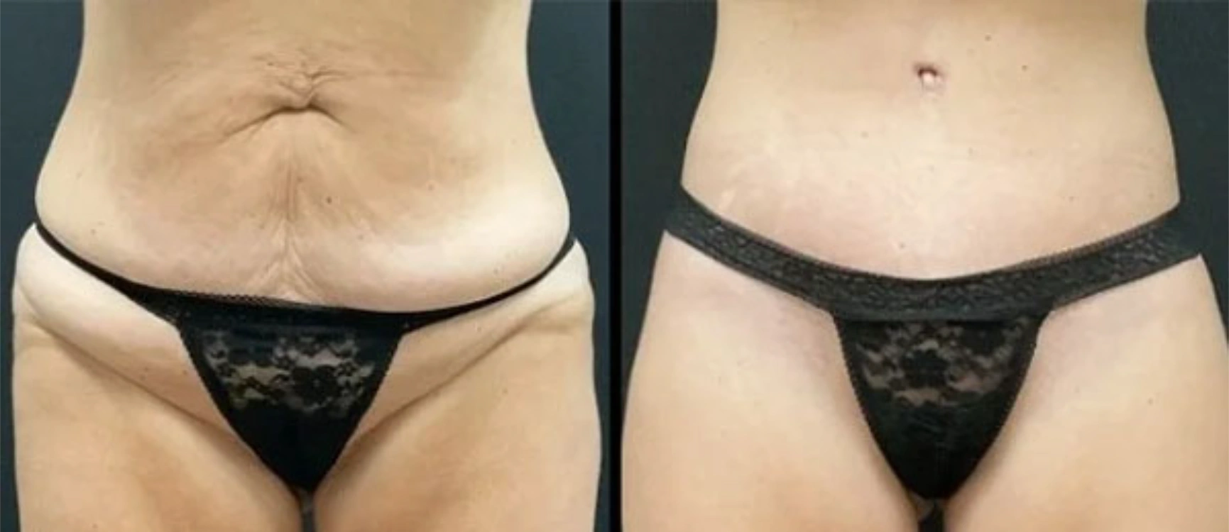 before and after tummy tuck before and after tummy tuck