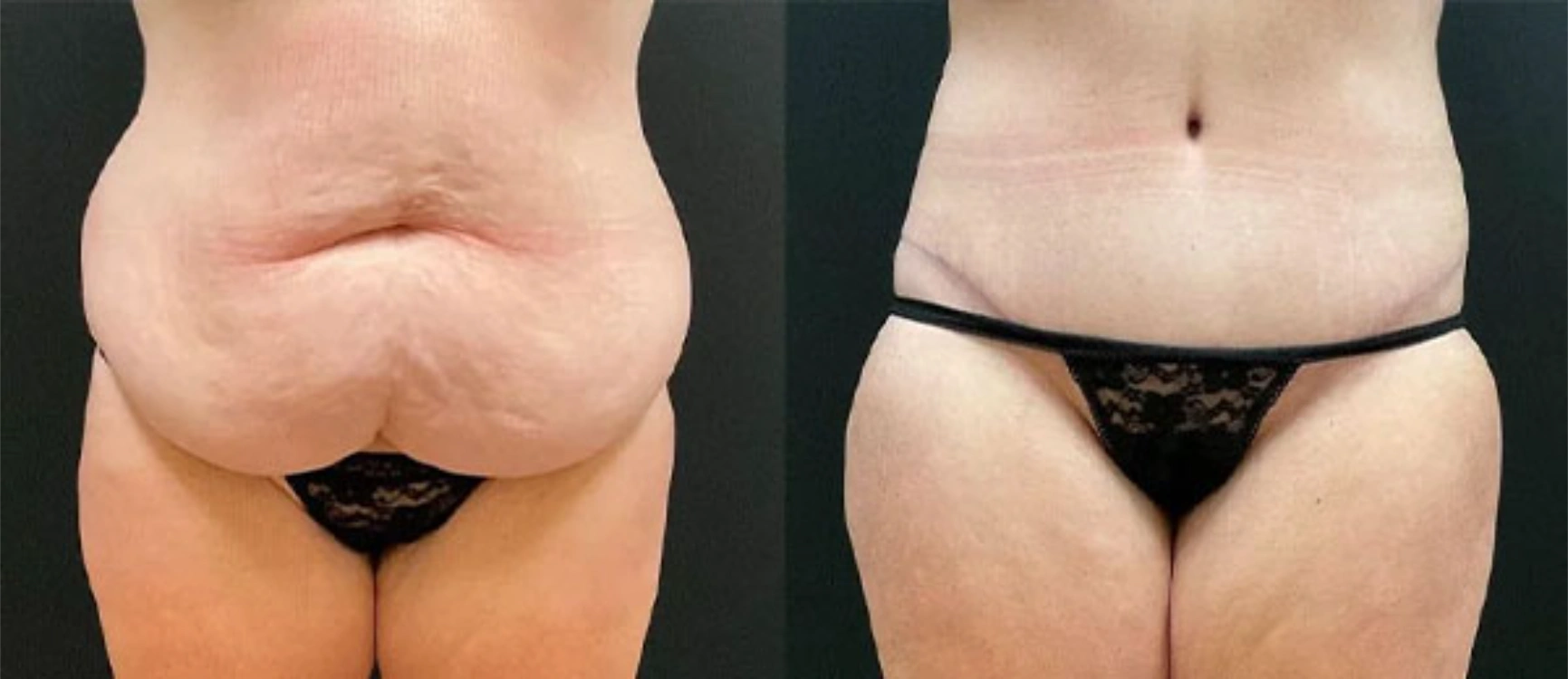 before and after tummy tuck before and after tummy tuck