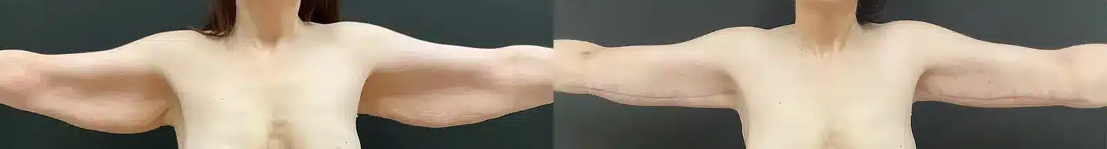 front arm lift arm contouring before and after photo by my plastic surgery group in carmel in
