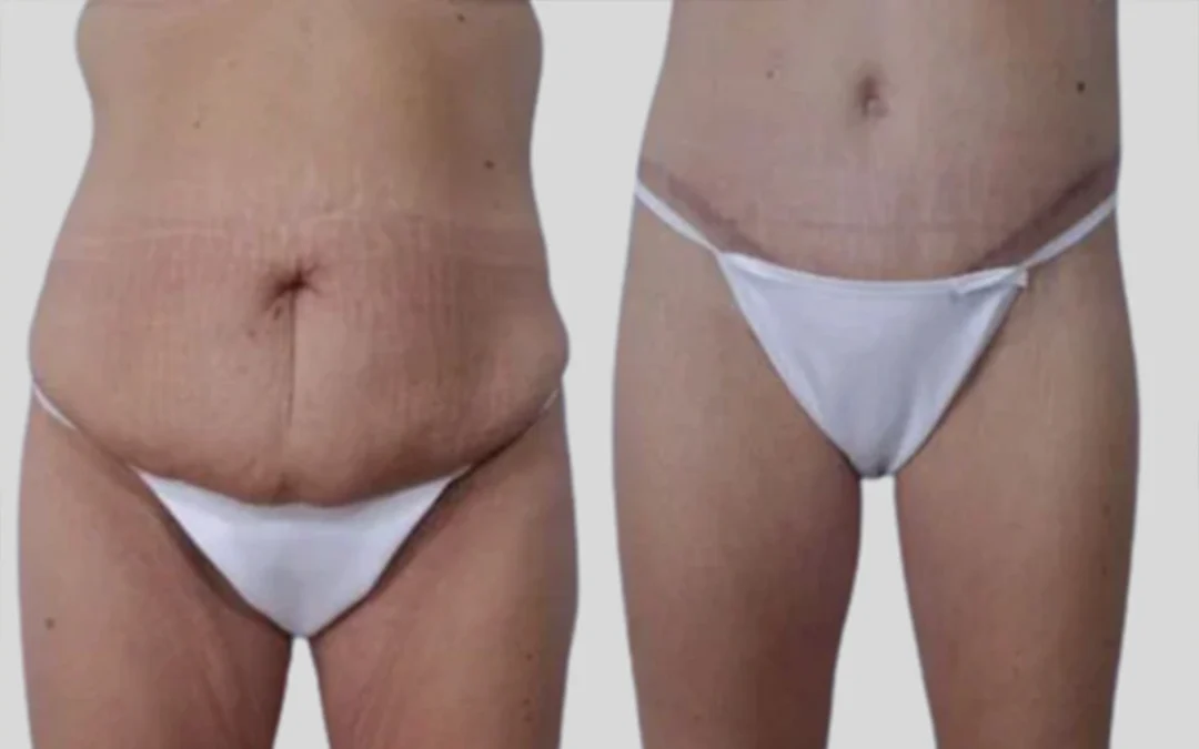 before and after post weight loss body lift 1 1080x675 copy before and after post weight loss body lift 1 1080x675 copy