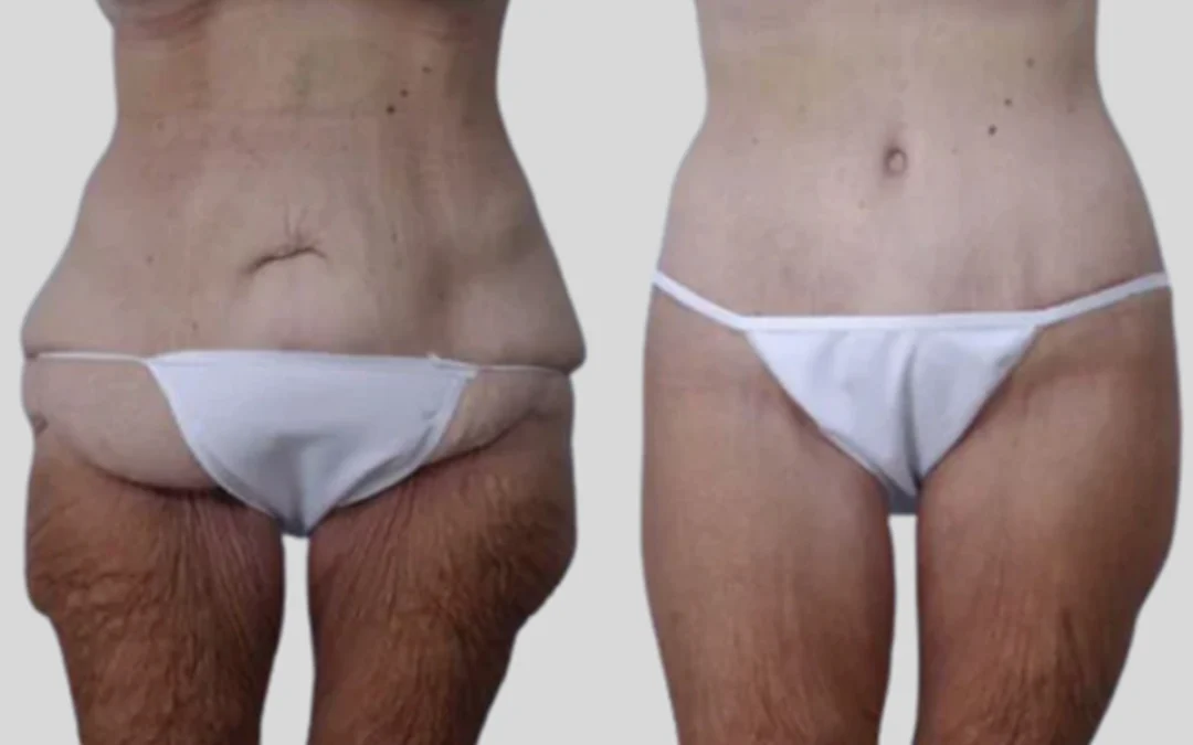 mpsg before and after body lift results (1) mpsg before and after body lift results (1)
